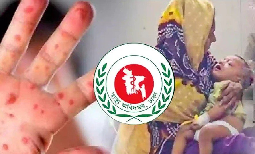 Record 17 Deaths from Measles and Suspected Cases in 24 Hours